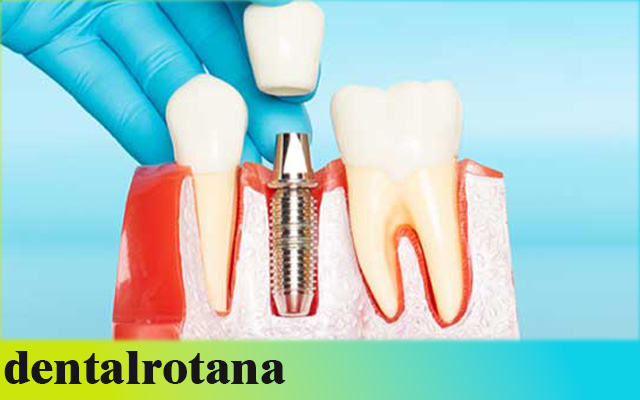 طب الأسنان في تركيا