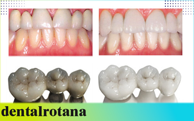 أفضل زراعة أسنان في تركيا
